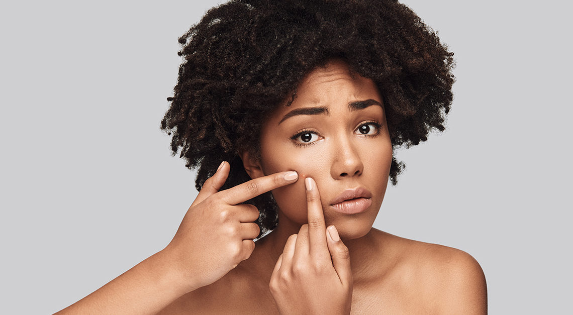 5 skincare mistakes that may worsen your acne